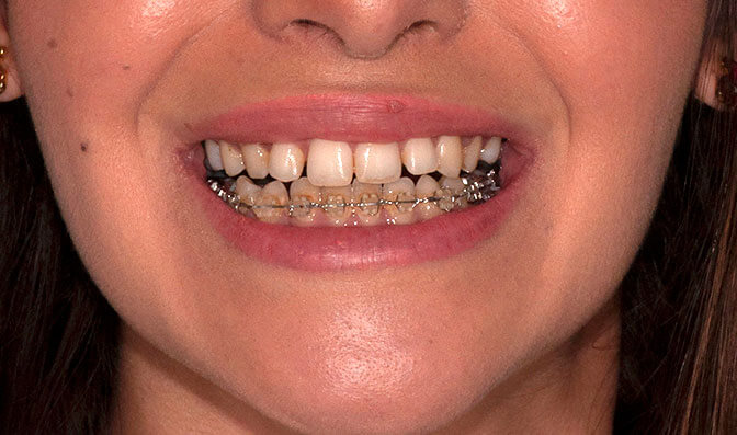 Dientes alineados antes de ortodoncia